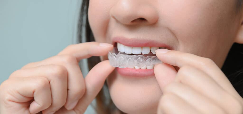Invisalign® & Braces Alternatives
