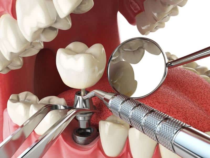 Illustration of dental implant surgery similar to what is performed by our dentist in Copperas Cove, TX