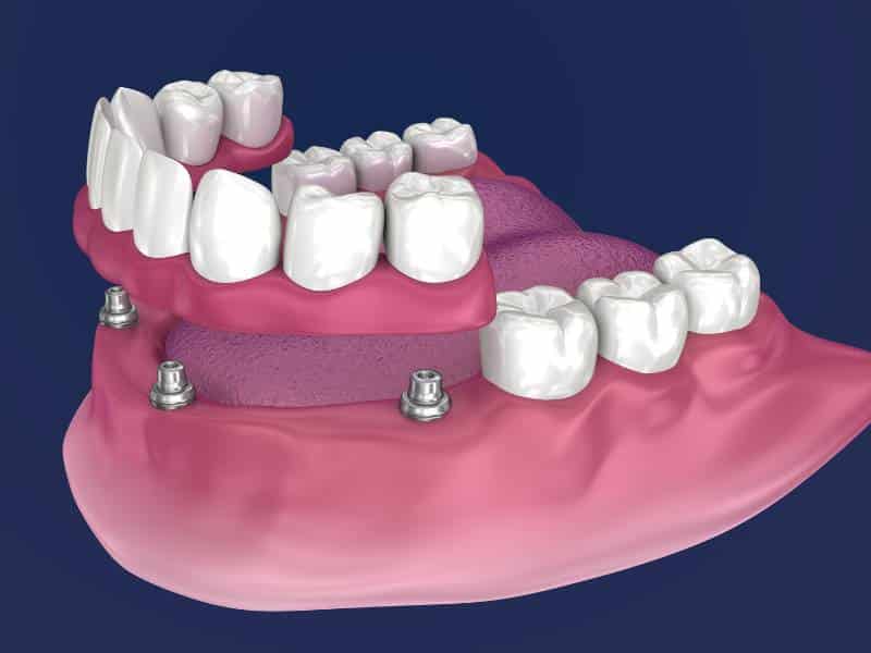 Illustration of an all on 4 dental implant in Copperas Cove, TX