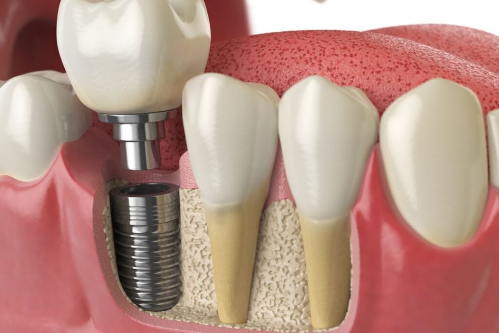 How Long Does It Take to Adjust to Eating with Dental Implants?