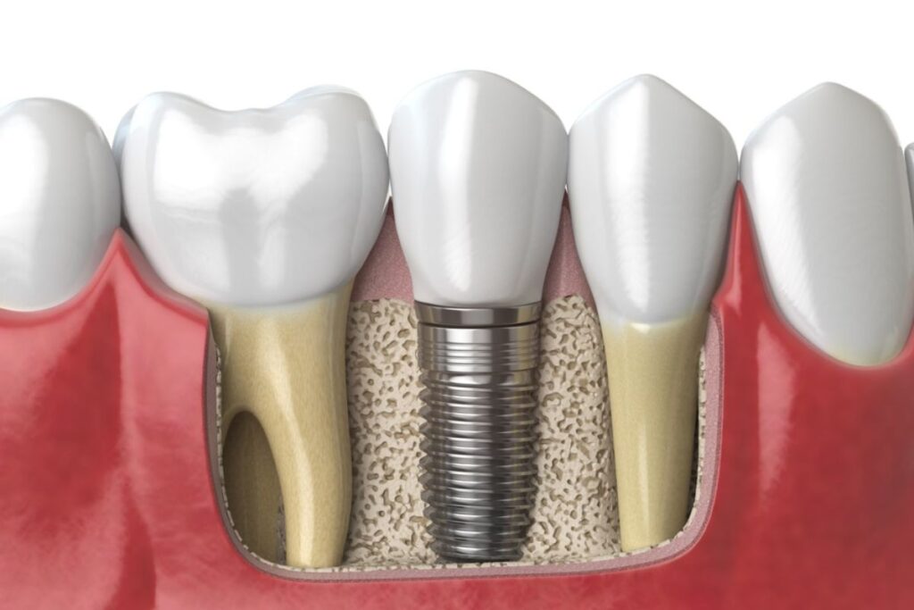 The Emotional Benefits of Dental Implants for Youth