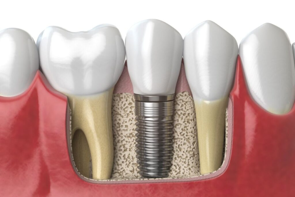 Is a Dental Implant Right for You?