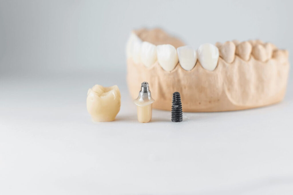 Can Dental Implants Help Prevent Bone Loss in the Jaw?