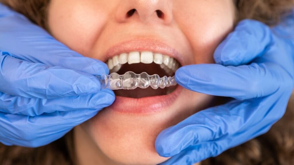 Why Invisalign Aligners May Not Fit Properly During Treatment